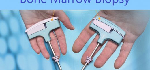 Bone Marrow biopsy